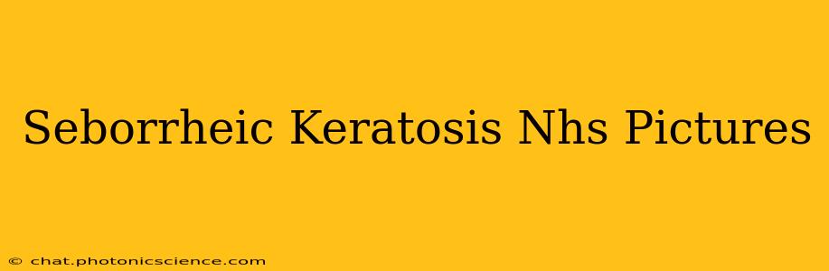 Seborrheic Keratosis Nhs Pictures